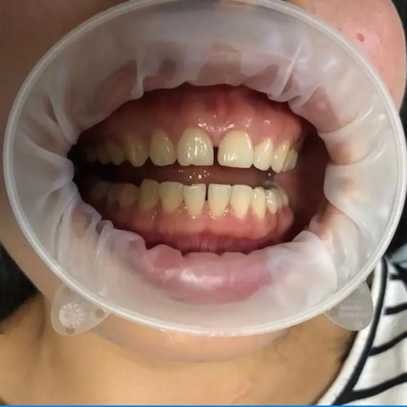 3D Dental otwieracz do ust wargi policzek zwijacz kształt O regularny mały rozmiar młodzieżowy