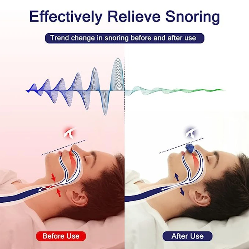 Anti Snoring Device Adjustable Wind Speed Devices Nasal Dilator Stop Snoring Nose Vents Plugs Suitable For Men And Women