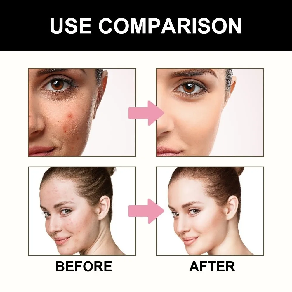 Alcohol Free Black Star Pimples Patch Non Irritating Ultrathin Pimples Covering Patch Gentle Formula Beauty Face Patch