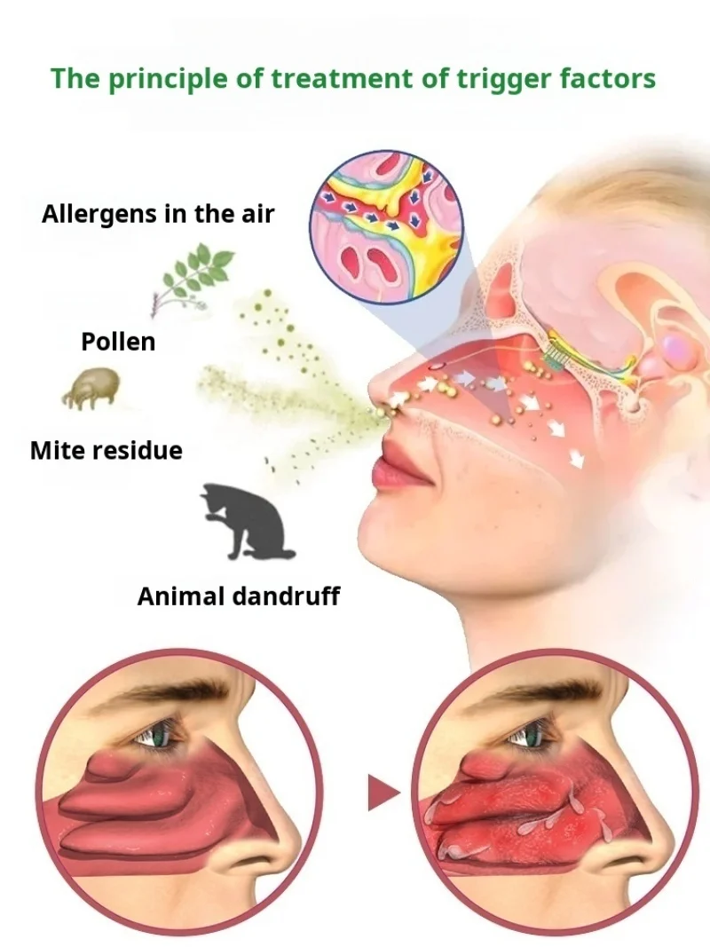 BioNase Nose Rhinitis Sinusitis Cure Therapy Nose Massage Hay Fever Low Frequency Pulse Laser Runny Sneeze Treatment Machine