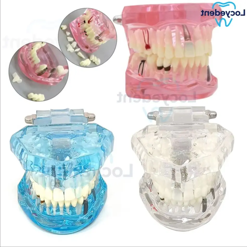 

Dental Teeth Model Teaching Model Implant Disease Teeth Repair Restoration Bridge for Dentist Teaching Studying Demo M2001