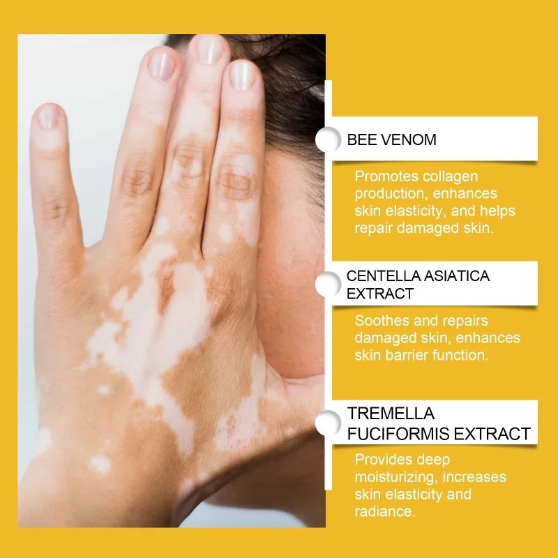 Bee Venom Vitiligo Soothing Cream Removal Skin Vitiligo Eliminate Vitiligo Treatment Skin Repair Cream for Adult and Children