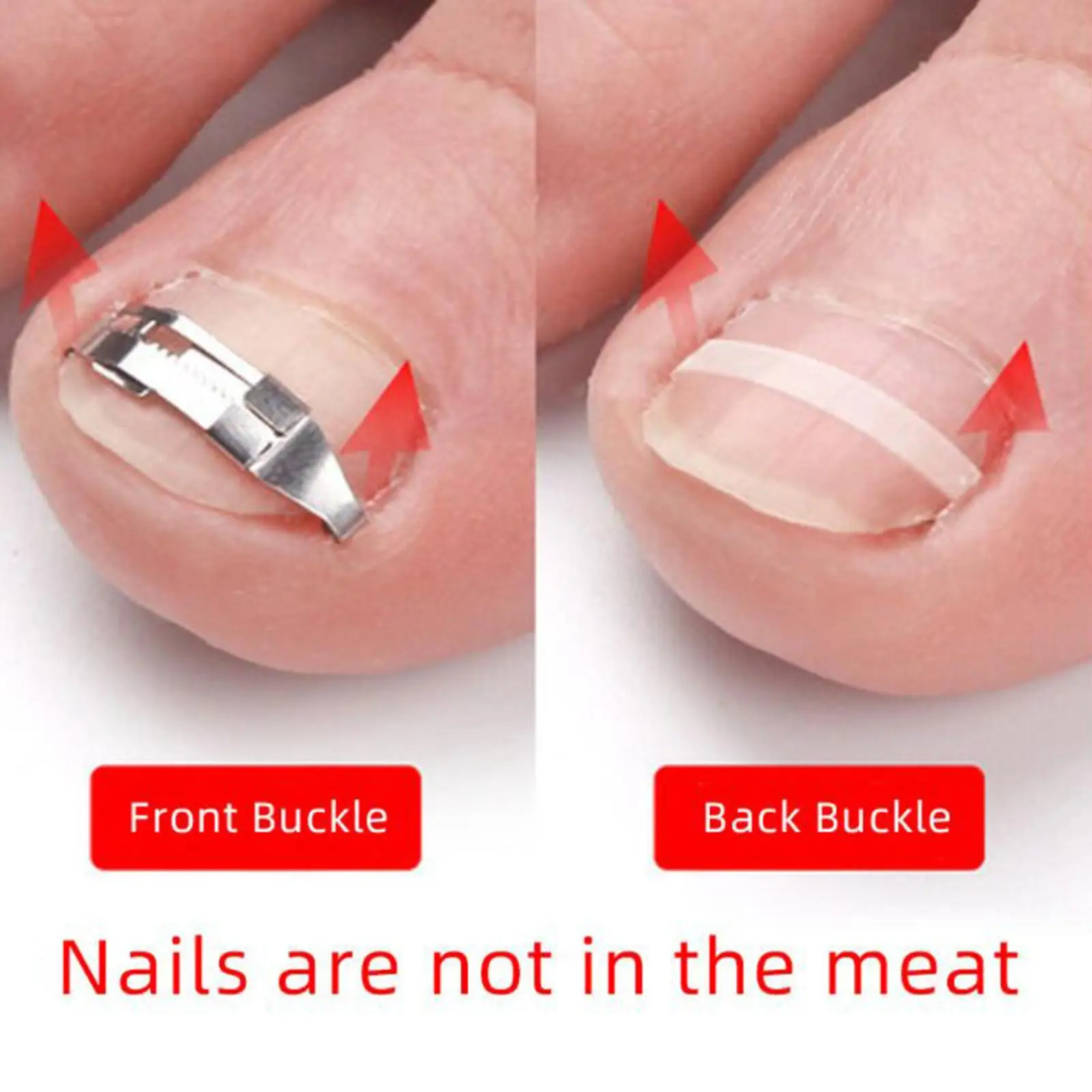 Toenail Correction Strips Adjustable Ingrown Nail Treatment Set Carbon Steel Beauty Tool for Women Foot Health