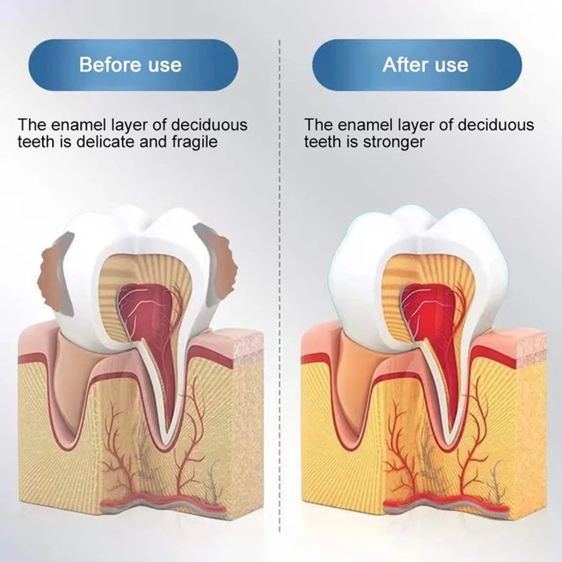 New Upgrade Quick Repair of Cavities Caries Removal of Plaque Stains Decay Whitening Yellowing Repair Teeth Teeth Whitening