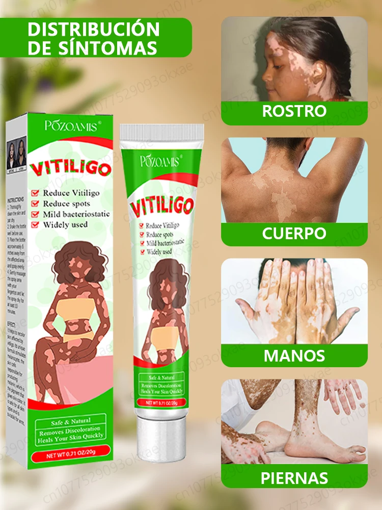 Crema de tratamiento del vitíligo para aliviar la eliminación de manchas blancas en la piel.