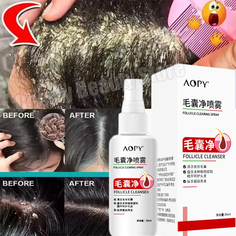 

Hair Scalp Treatment Spray Remove Dandruff Itching Oil Control Anti Loss Scalp Cleaning Repair Serum Beauty Hair Care Products