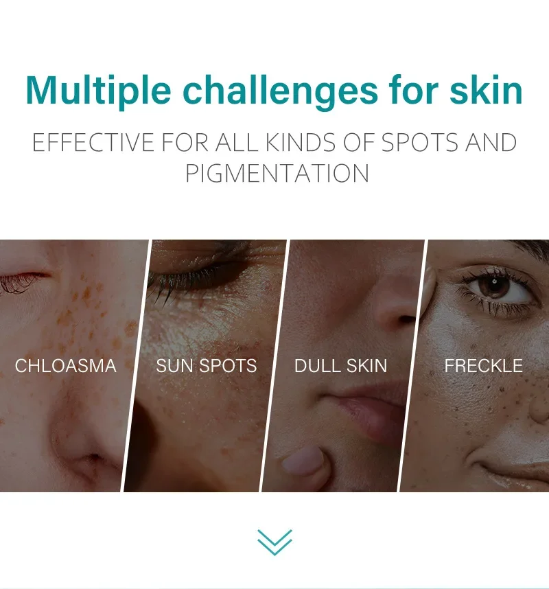 مزيل البقع الداكنة لإزالة الوجه والبقع الداكنة والنمش والكلف والعمر والشمس