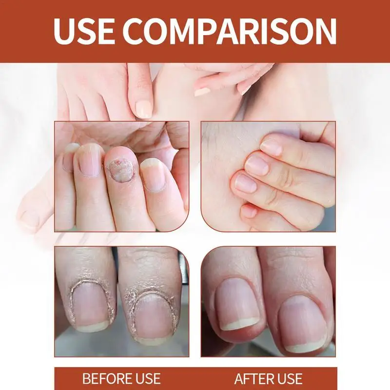 Natural Nail Strengthener Nail Repair Nail Care Essence Providing Rich Nutrition And Aiding In Nail Repair Nail Care Product For