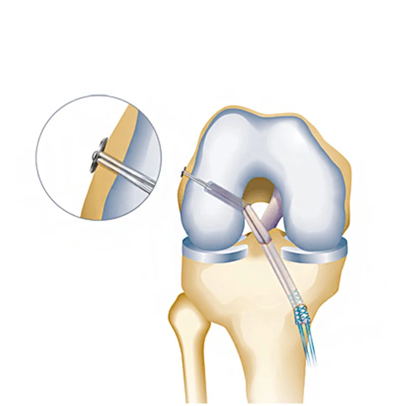 Knee Femoral Ligament Reconstruction Cortical Button Fixation Acl Reconstruction Adjustable Loop