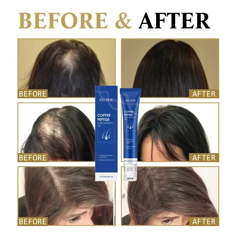 إنتاج Nsucciss،99% des acheteurs acheteurs achéteront ànouveau، its ont de plus en plus de cheveux، disent Alfa à la calvitie، Cheveux épais