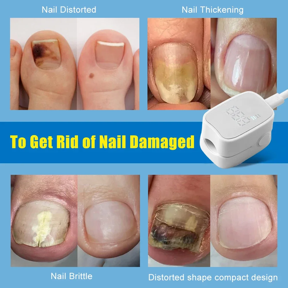 Nail Fungus Laser Treatment Effectively Remove Toenail Repair Laser for Nail Fungal Decvice Onychomycosis Therapy Treat