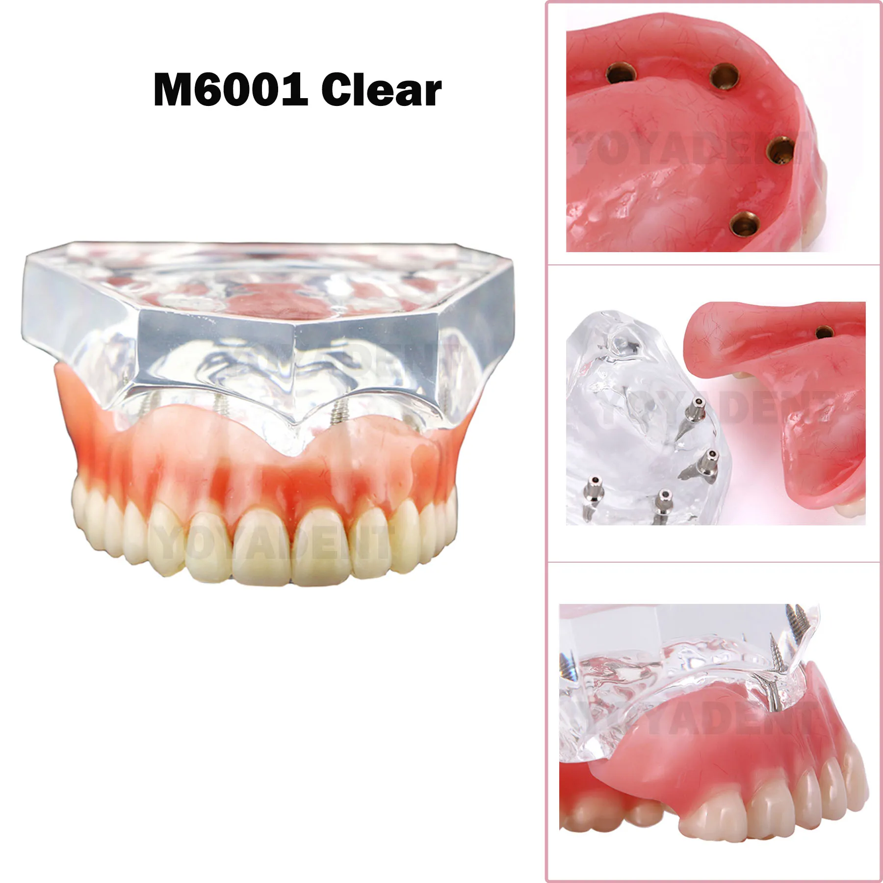 Dental Upper Lower Teeth Model Removable 4 Implants Model For Dentist Studying And Researching M6001/M6003