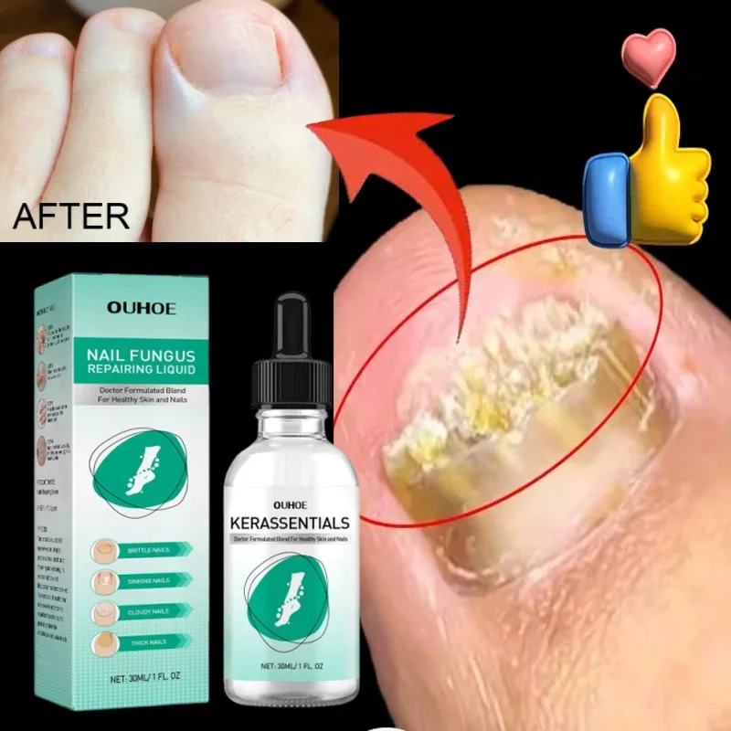 

Extra Strong Nail Fungus Treatment Serum Essence oil Care Repair Essence Anti Toe Infection Gel Feet Cream Removal Nails Fungal