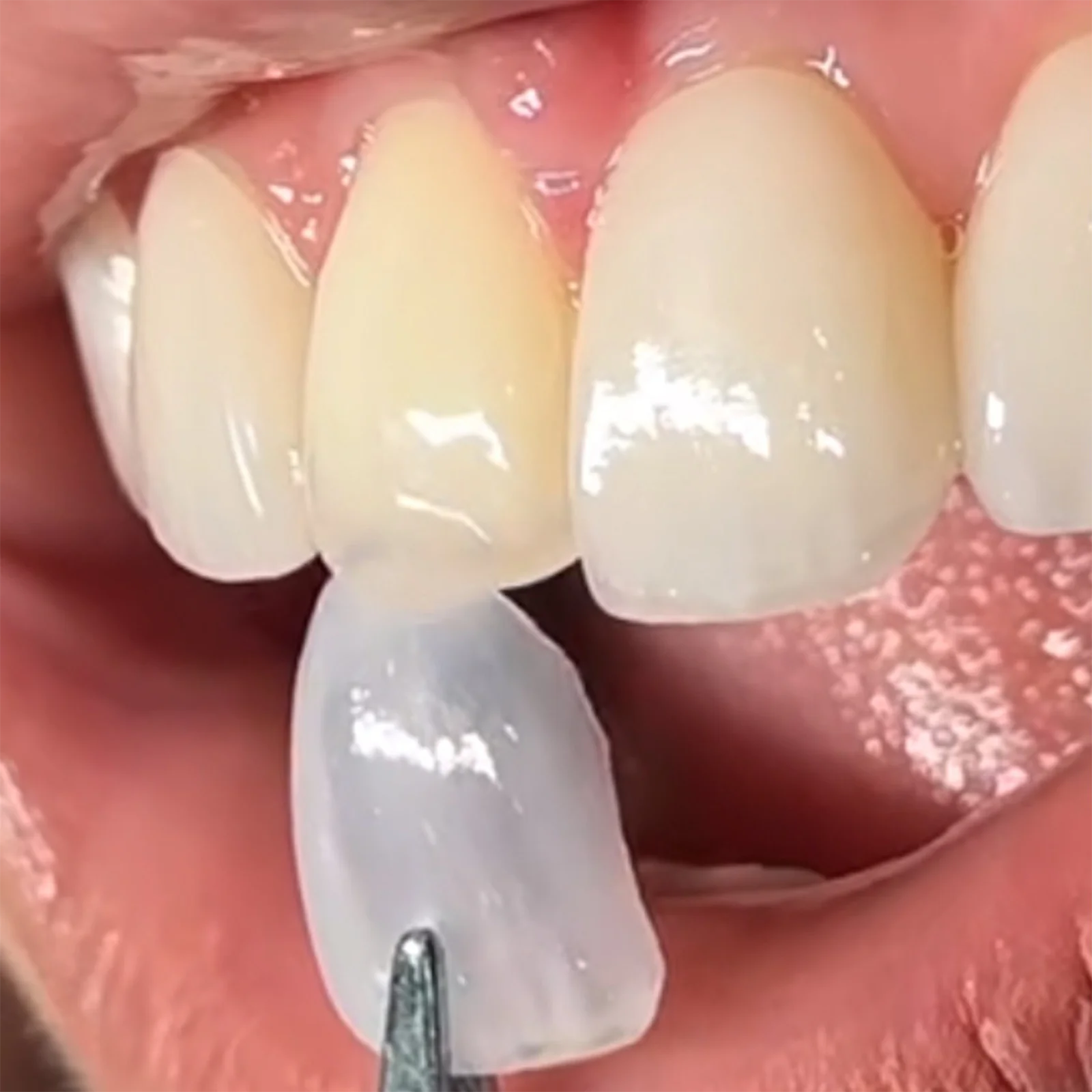 Lodden 10 Stück Pressbarren Dental Glas Keramikpresse Lithium-Disilikat Dentallabormaterialien