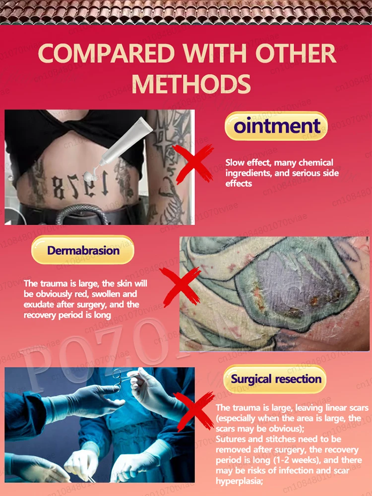 Rimozione del tatuaggio e rimozione del colore