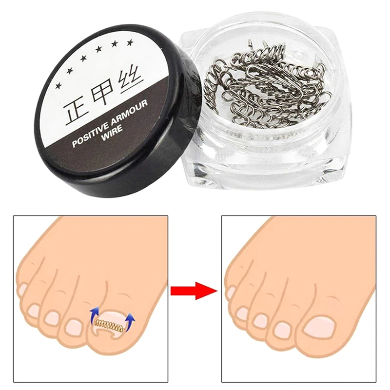 Fixador de fio para correção de unhas encravadas, pedicure, paroníquia, recuperação de unhas dos pés, corretor com arquivos de correção de dedos, ferramenta de cuidados com os pés