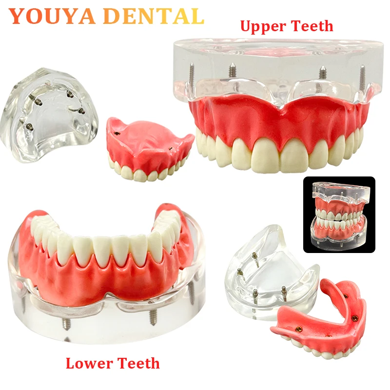 

Dental Implant Denture Model Upper and Lower Jaws with 4 Nails Covered Denture Implant Model Dental Research Teaching Model