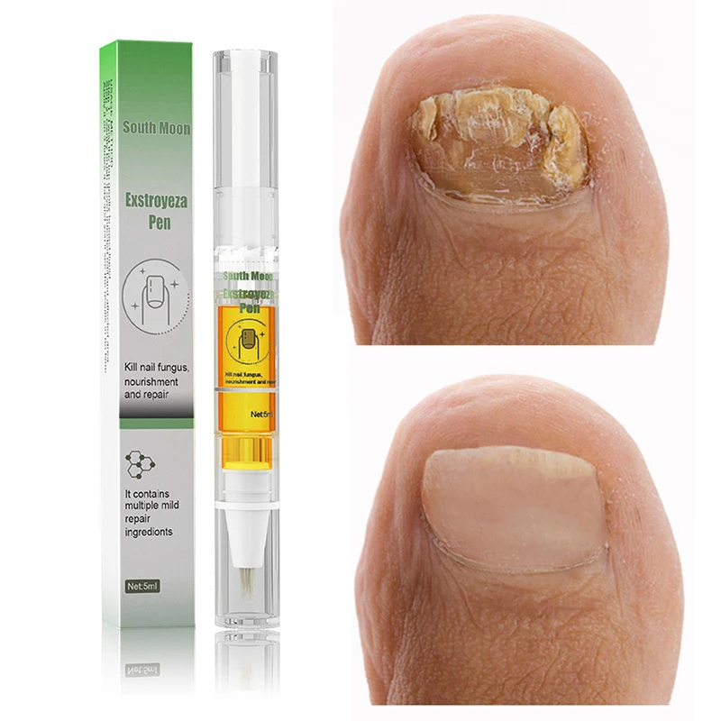 

Nail Fungal Treatment Feet Care Essence Anti Infection Onychomycosis Foot Toe Nail Fungus Removal Gel Nail Renewal Liquid