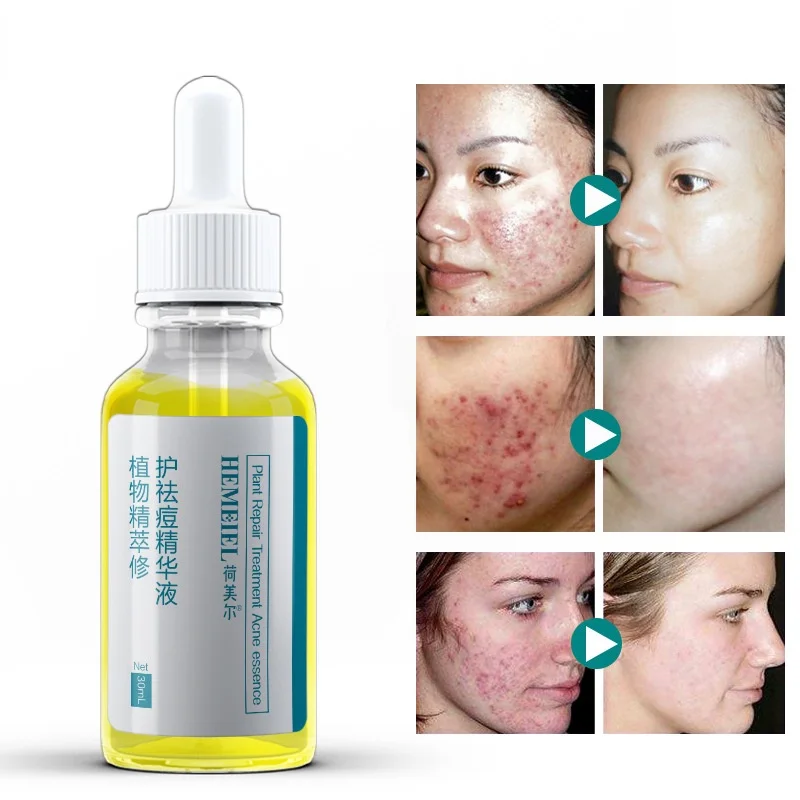 

30ml Plant Acne Removing Essence Mildly Repairs Acne Pits Acne Marks Acnes Blackheads Shrinks Pores Acne Treatment Serum