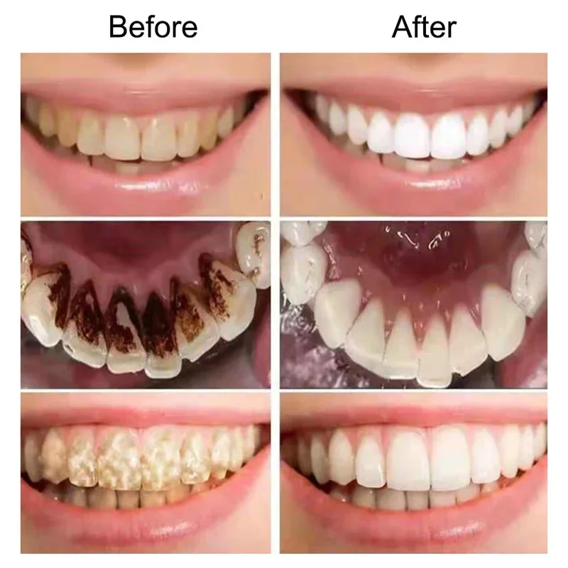 Teeth Whitening Serum Remove Stains Smoke Coffee Plaque Deep Cleaning Dental Oral Hygiene Fresh Breath Tooth Care Products