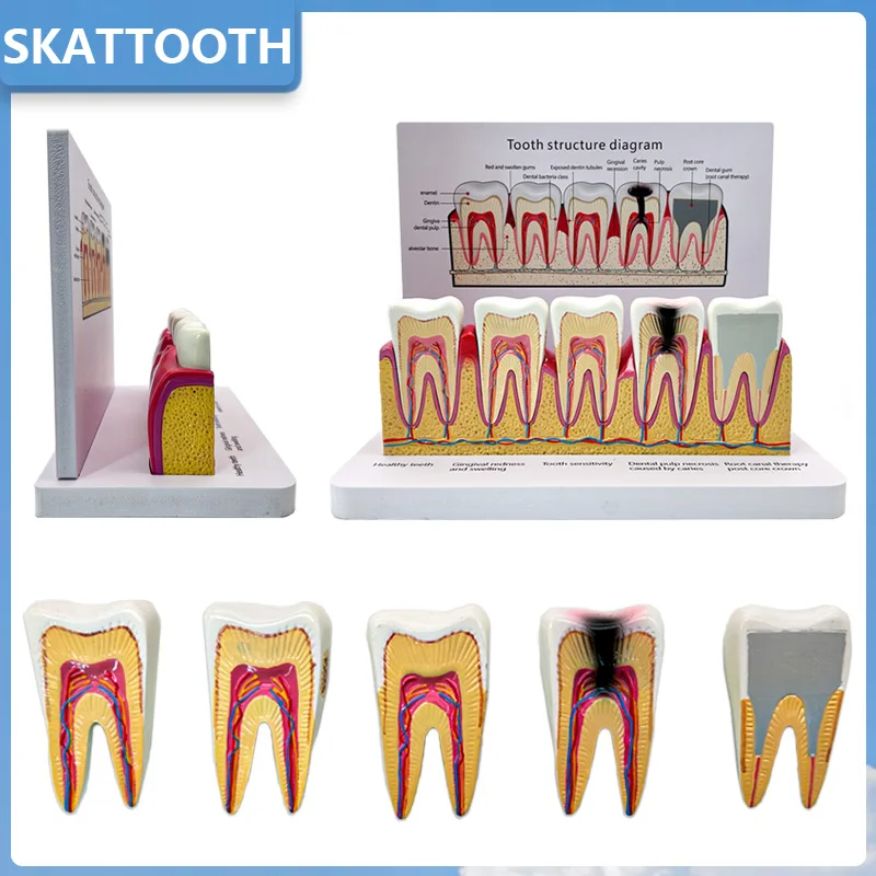 New Dental Root Canal Teeth Structure Anatomical Model Standard Oral Teeth Demonstration Model Removable Dentisit Teaching