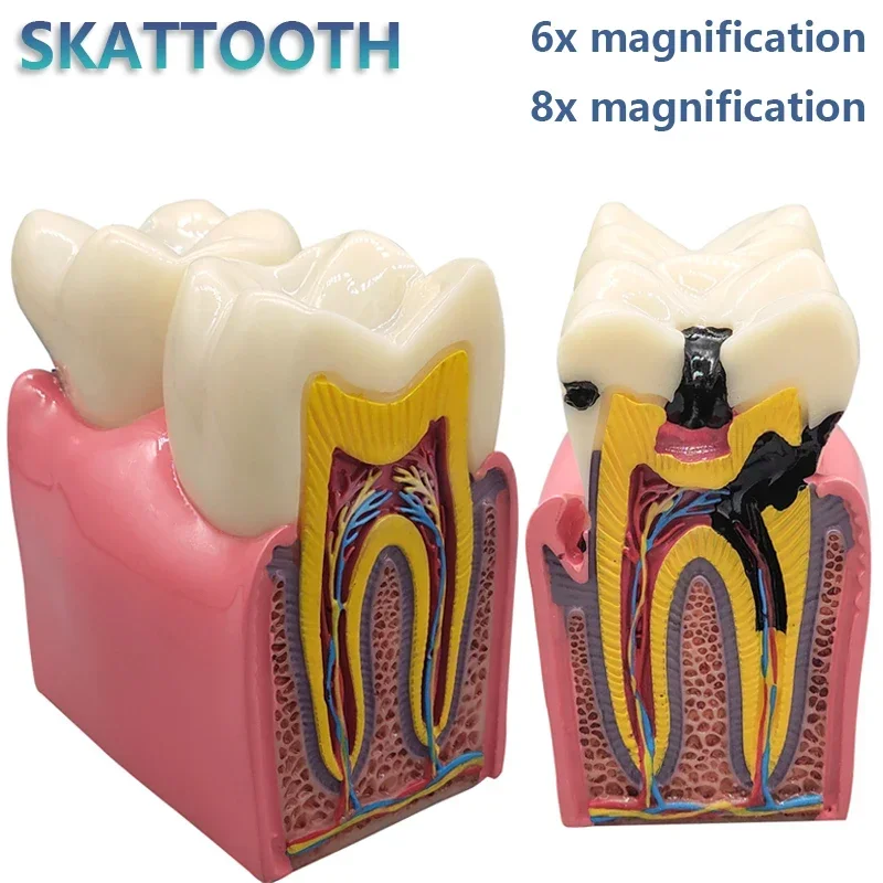 8-krotny model próchnicy dentystycznej Choroba zębów Model dentystyczny do demonstracji dentystycznej Model dentystyczny Nauczanie laboratorium