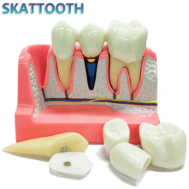 Dental Implant Model Crown Bridge Removable Porcelain Teeth Model for Dentist Teaching Model Doctor-patient Communication