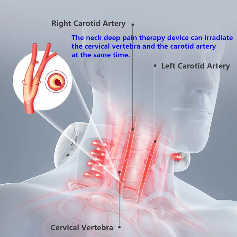 Ohio eur laser LLLT 650nm pour la thérapie de la spondylite cervicale, traitement des étourdissements et des maux de tête, dissolution de la plaque cartiendra de du cou oto