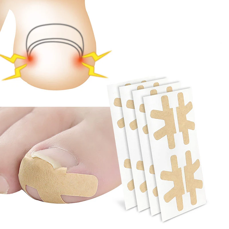 2/4pair Nail Repair Patch Toenail Fungus Patch Sticky Nail Ingrown Correction Sticker Toenail Care Paronychia Nail Patch