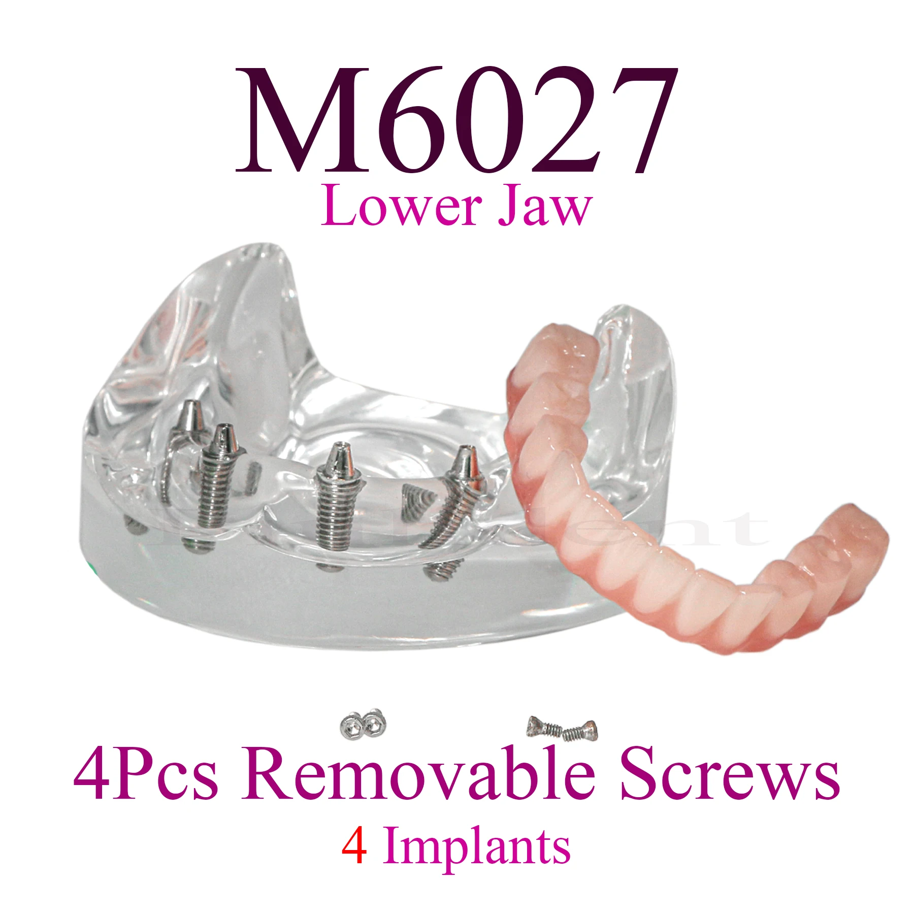 Mandibular Dental Implant Teeth Model M6027 Clear Lower Jaw 4 Overdenture Type Modle With 4 Removable Screws For Studying