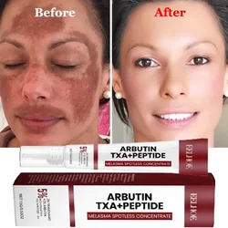 Spot Removing Whiten Cream Powerful Brighten Skin Fast Eliminates Melanin Pigmentation Melasma Dark Spots Skin Care New 2024