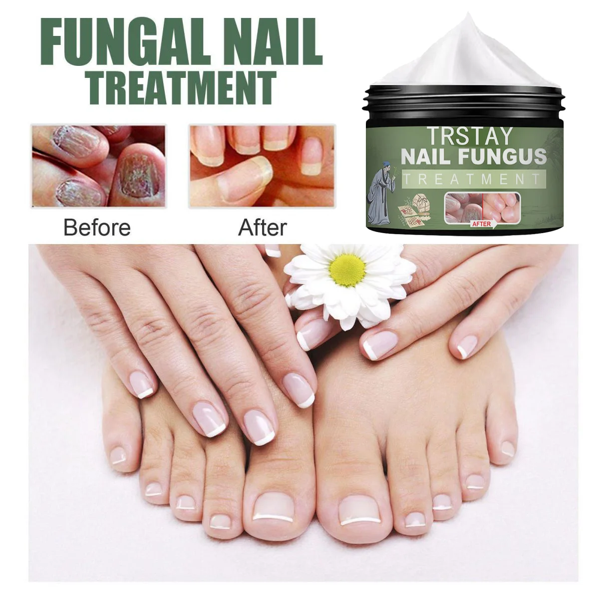 Nail Fungal Treatment Cream