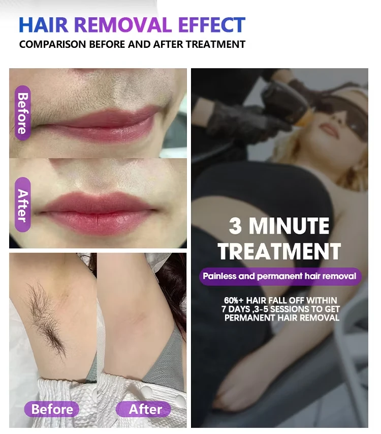 808nm Diodenlaser Haarentfernungsmaschine 3500W Enthaarungsausrüstung Drei Wellenlängen Ice Titanium Gerät Professionell für Salon