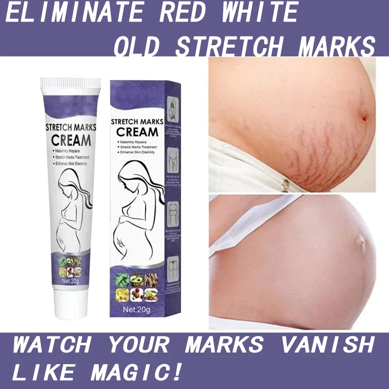 

Stretch Marks Remove Cream Improves Elasticity Firm Lift Skin Cream Effective Remove Marks After Pregnancy Maternity Nourishes