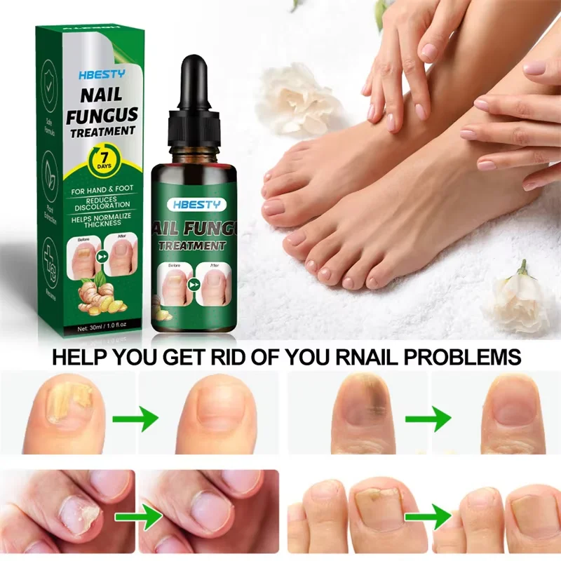 Sérum de traitement des champignons des ongles, 7 jours, gingembre, Anti-infectieux, Paronychia, onychomycose, orteil, pied, réparation fongique des ongles, Gel, soins des mains et des pieds