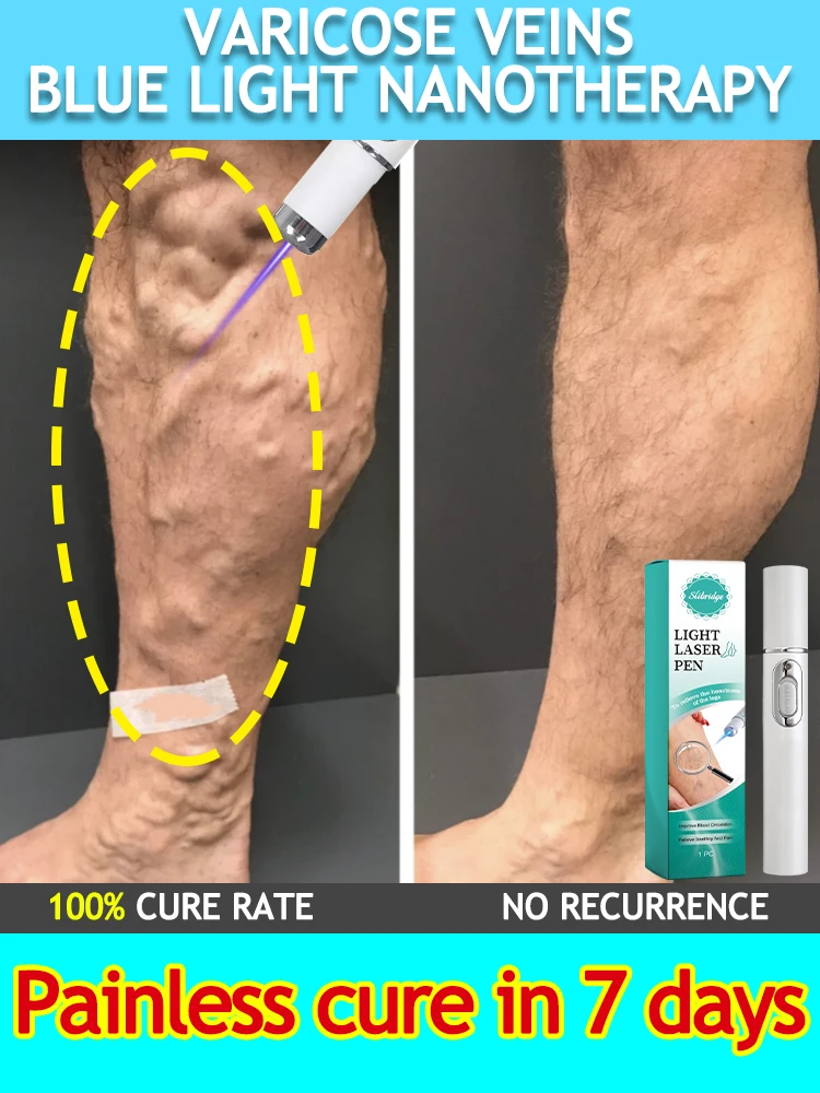 Laser vein Medical level