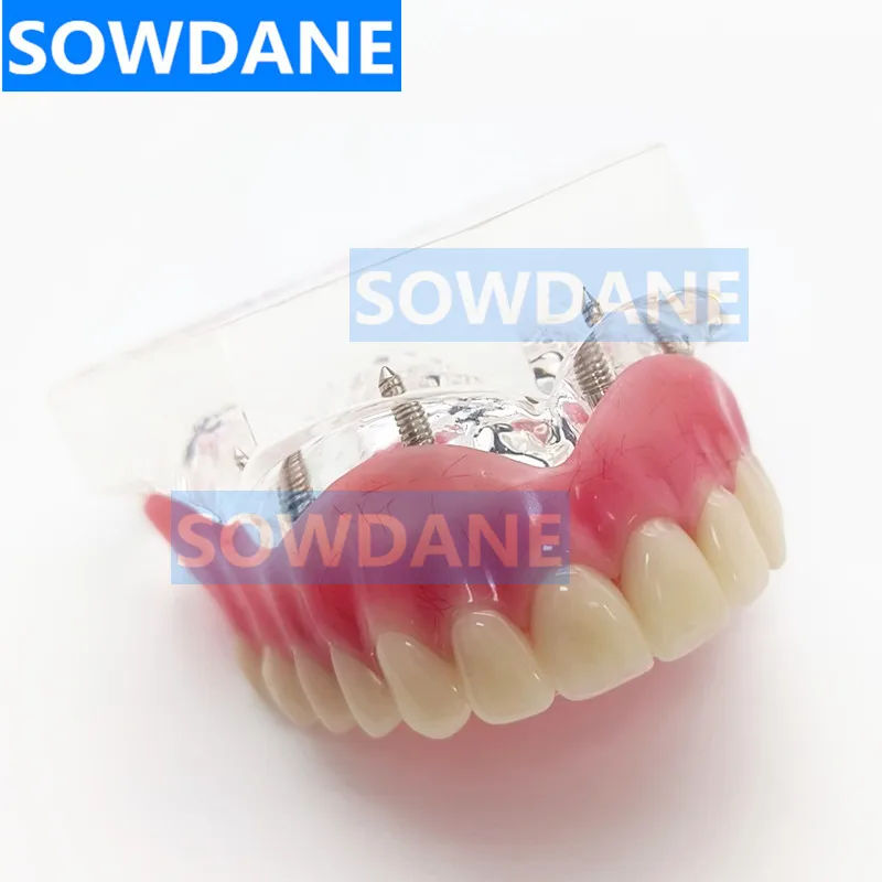 Dental Implant Restoration Teeth Model Removable Bridge Denture Disease Teeth Model With Restoration Bridge Teaching Study