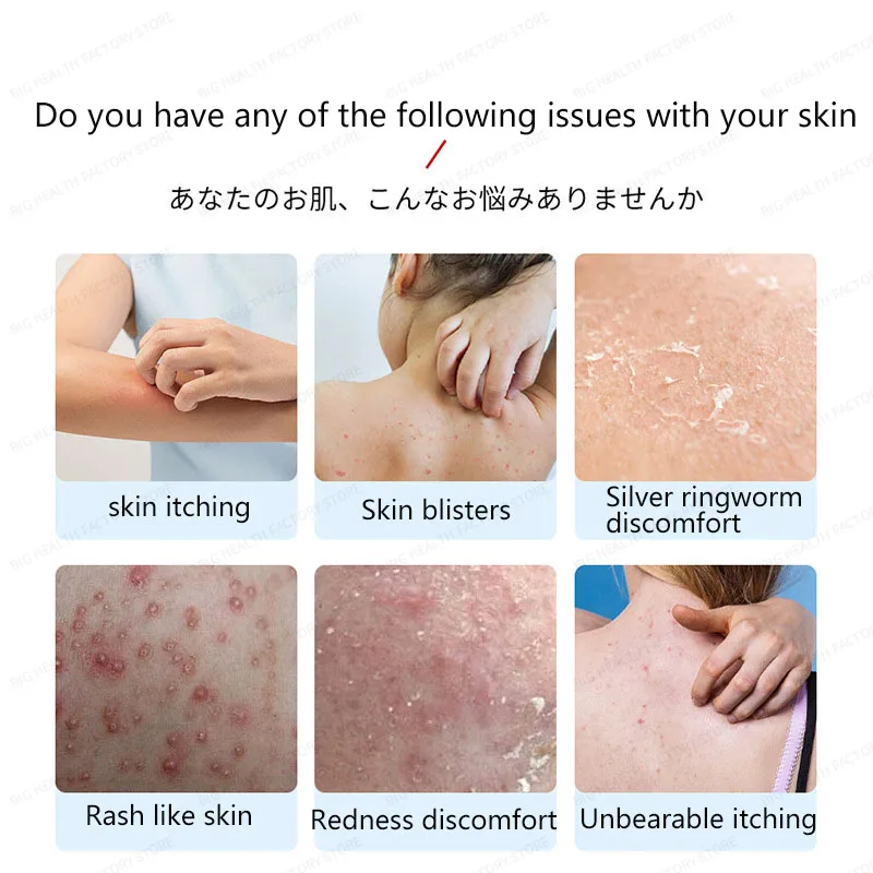 Tinea Kangjing Spray alivia el molestio de la piel, las manos, los pies, el cuero cabelludo y la solución externa para el cuidado de la salud