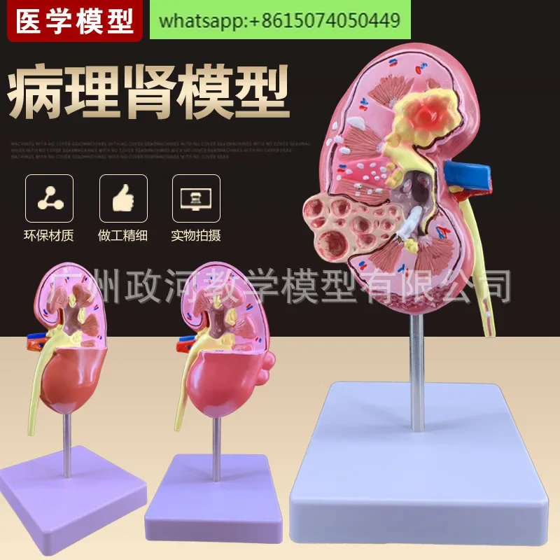 Teaching simulation pathological kidney model pathological kidney specimen renal anatomy model human anatomy model teaching aid