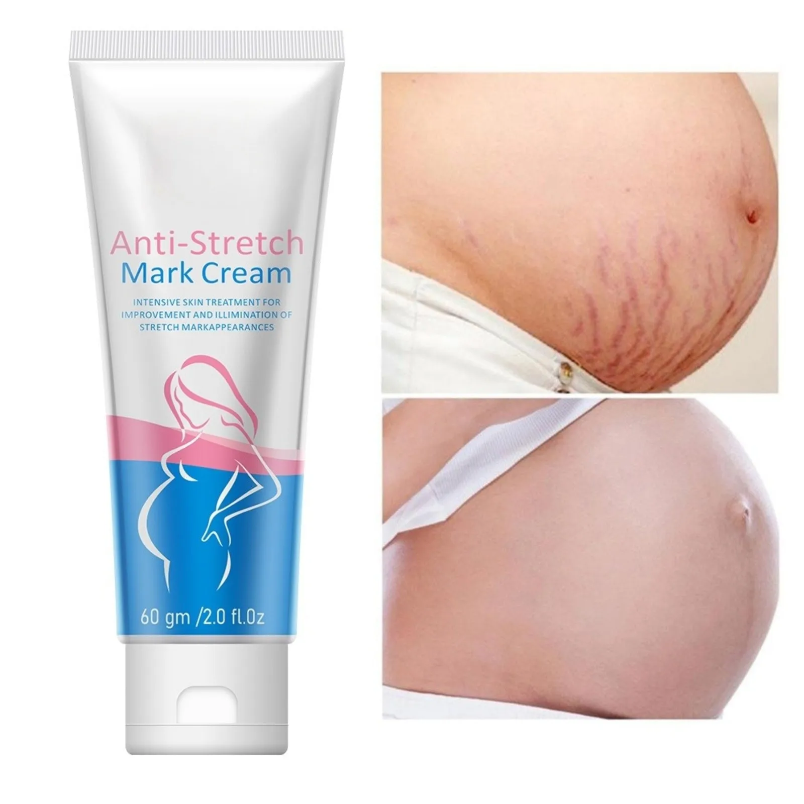 Body Stretch Mark Cream Is Refreshing Non-greasy Moisturizing And Stretch Marks Effective Stretch Mark Cream Festival Gifts