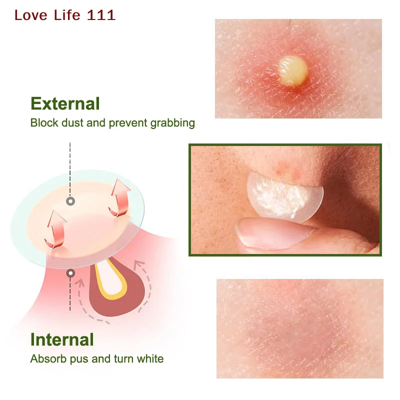 New 1/5Pcs Acne Patch Invisible Hydrocolloid Concealer Acne Patch Light Breathable Suction Pus Essential Oil Acne Patch