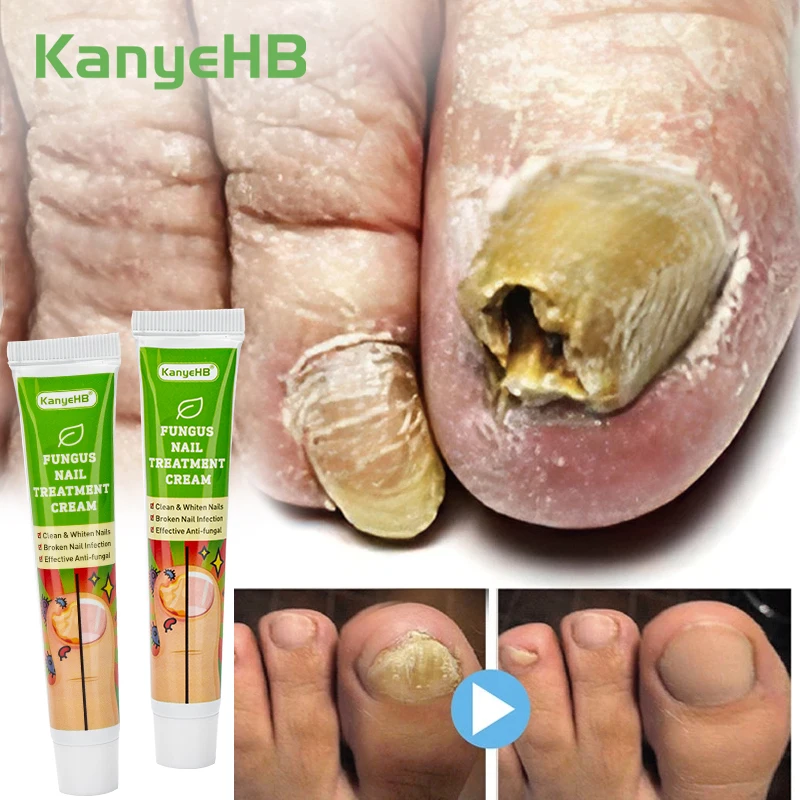 

2Pcs Fungal Nail Treatment Cream Hand Foot Toe Repair Herb Ointment Nail Fungus Removal Anti Infection Paronychia Nail Care A652