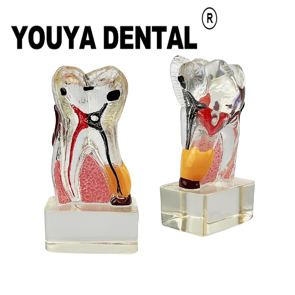 

Dental 4 Times Transparent Molar Anatomy Model Teeth Teaching Model For Dentist Student Practice Studying Demonstration Module