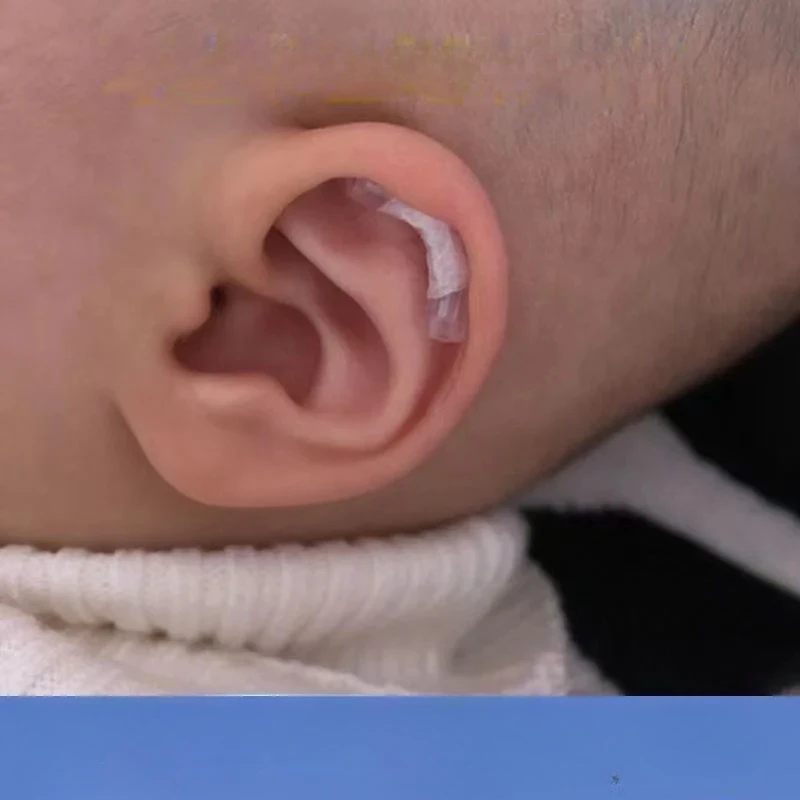 Newborn Ear Brace Baby Ear Stickers