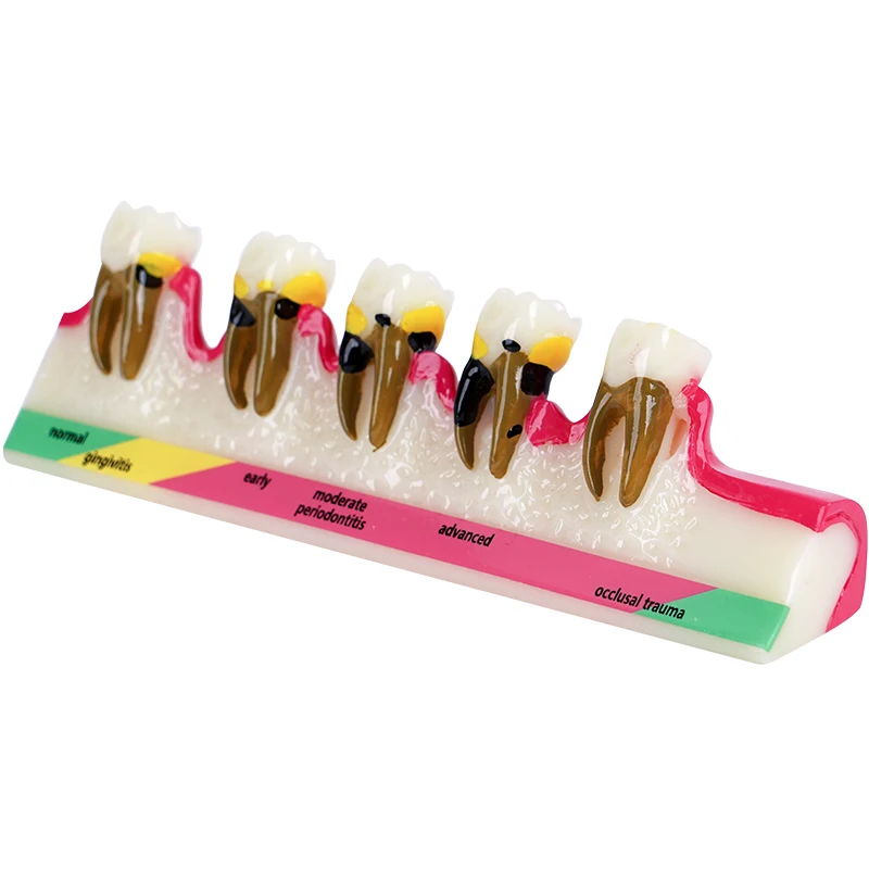 

Модель стоматологических заболеваний. Модель обучения зубами. Модель заболеваний пародонта. 5-ступенчатая болезнь. Ассорти. Демо-кариес для обучающей модели.