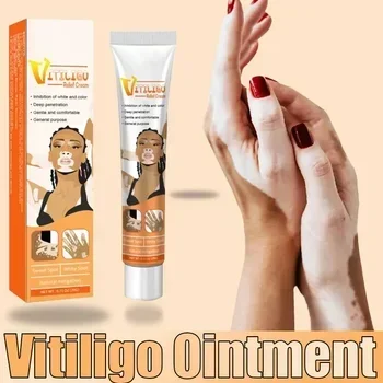 Schön, entfernt effektiv Vitiligo-Salbe, Ringelflechte, entfernt weiße Flecken und entfernt die Haut Vitiligo und beseitigt Vitiligo-Hautpflege