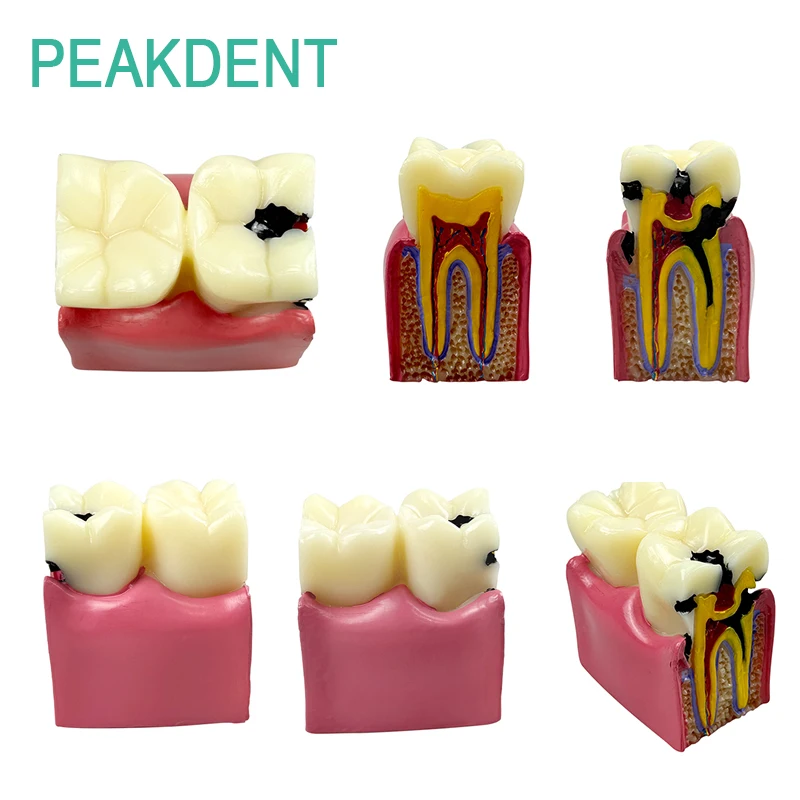

1Pcs Dental Tooth Model 6 Times Caries Models Comparative Demonstration Research Teaching Model Research Dental Products
