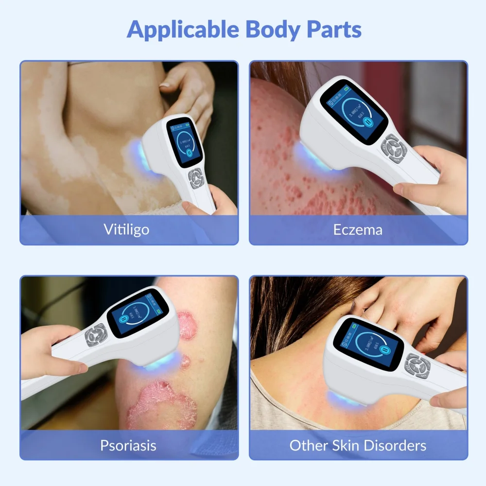 Handheld 308nm Excimer Light Therapy Lamp Upgraded Professional UVB Phototherapy 49 Diodes for Vitiligo Psoriasis Fast Shipping