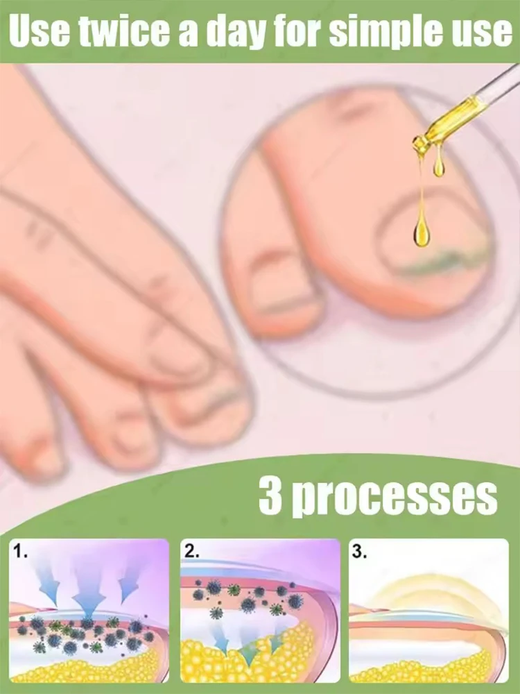 2025 핫 세일 손톱 문제는 이제 안녕! 간편하고 편리합니다