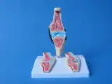 Medical anatomical model rheumatoid arthritis model
